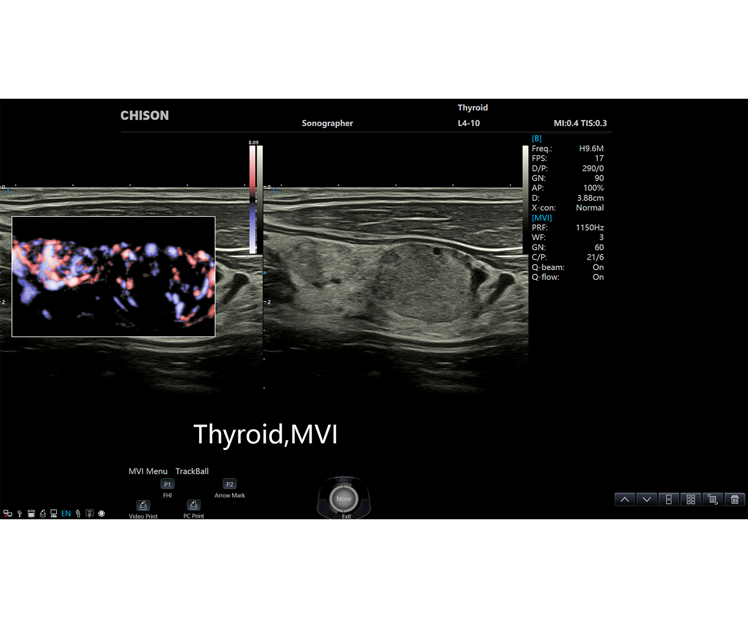 SonoPort Tiroides MVI